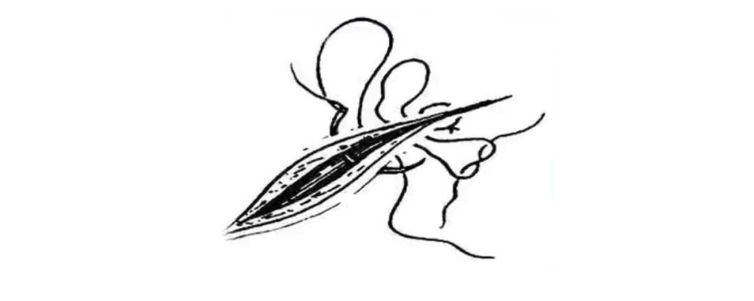 外科缝合技巧你熟练吗,外科缝合术的操作步骤