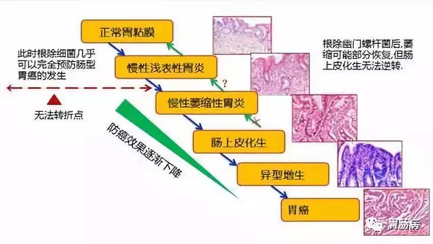 从胃炎到胃癌需要四步,从胃炎到胃癌的发展过程