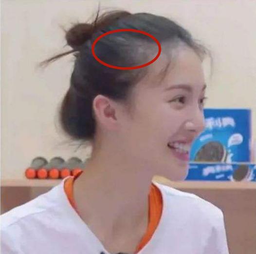 盘点女明星发际线危机,女明星秃头前后对比