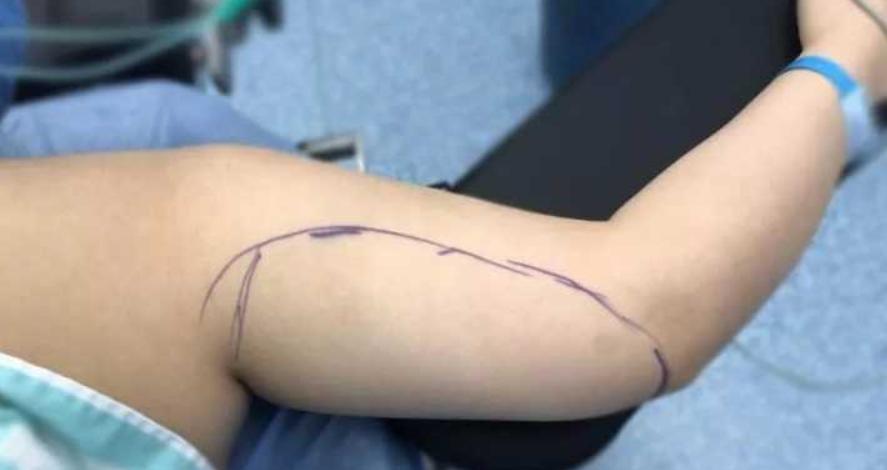 瘦手臂最快的方法吸脂,吸脂瘦手臂前后对比图