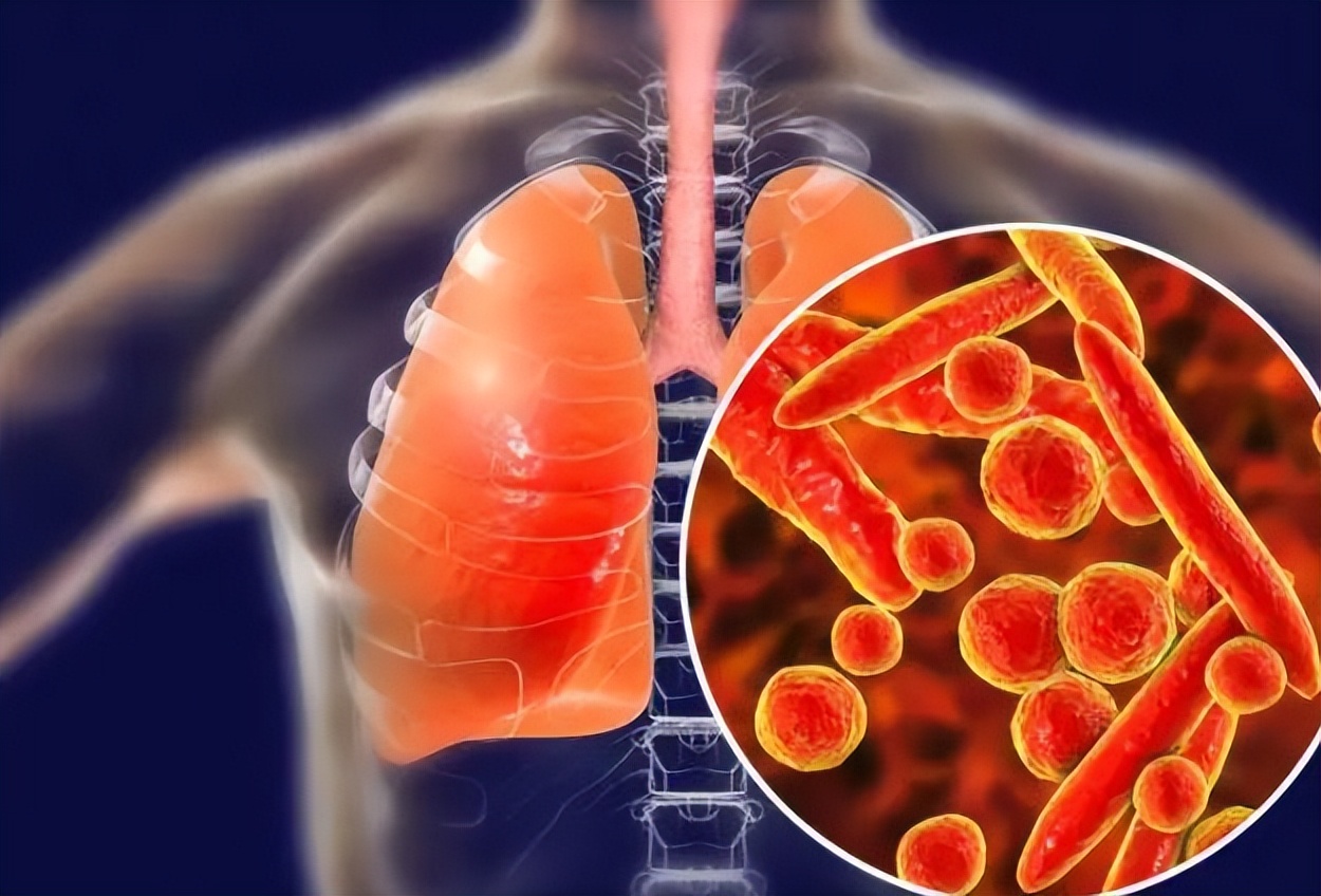 冬春咳黄痰是什么原因,黄痰是白肺征兆吗