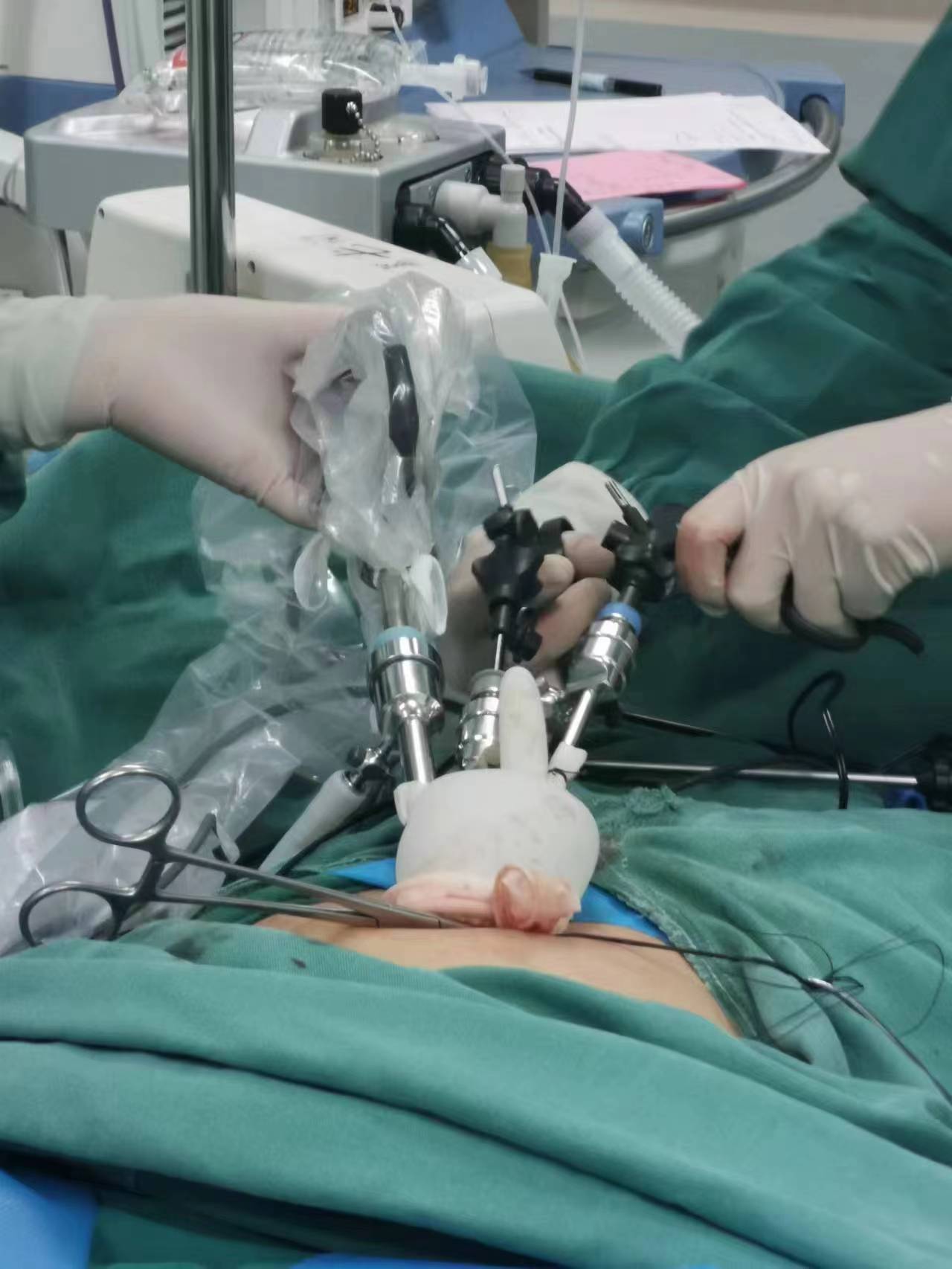 单孔腹腔镜手术为女性健康护航,水矿总医院普外科