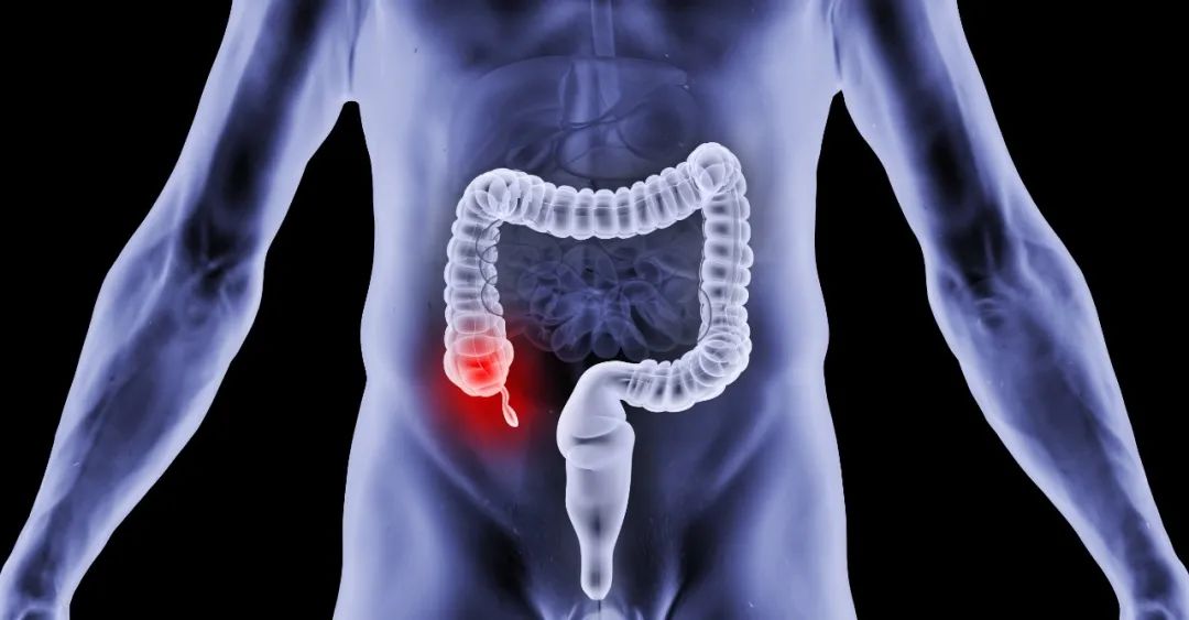 结肠癌术后化疗方案的制定策略,结肠癌手术后热灌注化疗能根治吗