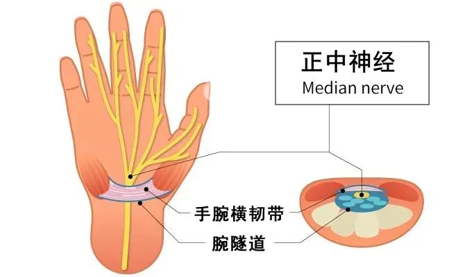 手痛、手麻？可能是腕隧道症候群