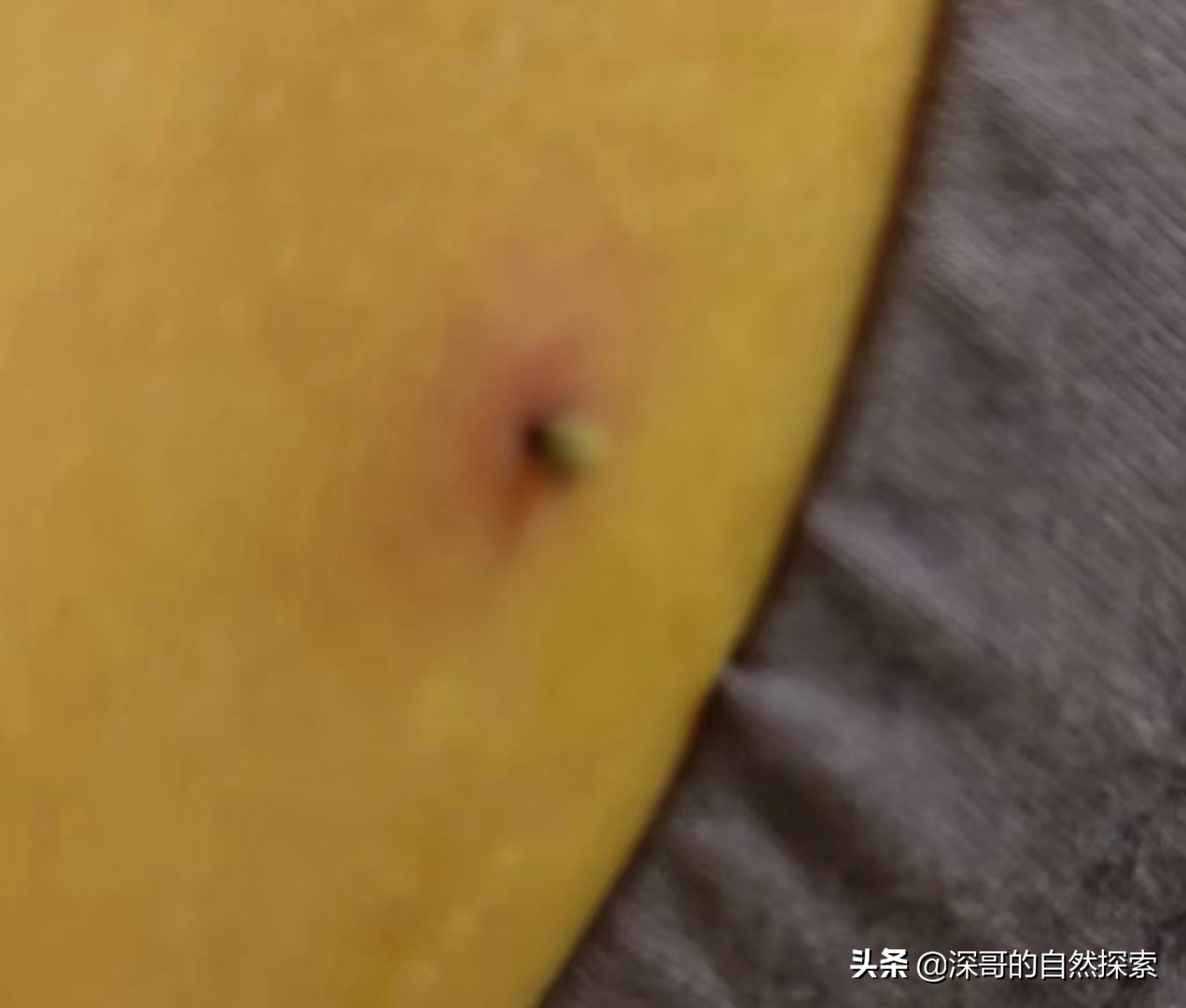 在深圳被小黑虫咬了,户外游玩被蜱虫咬到的视频