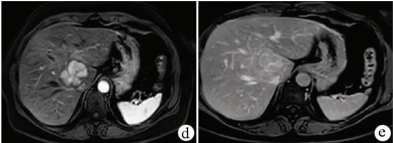 肝脏良性血管瘤,肝脏实性占位考虑肝血管瘤可能