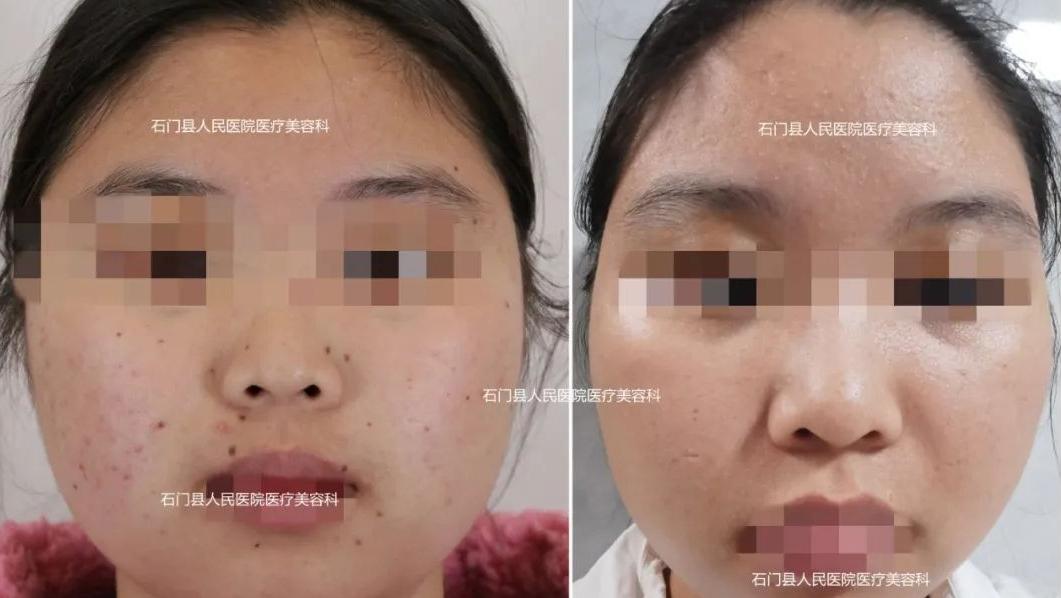 美丽无需“痣”疑！有痣别乱点，这些方法最靠谱