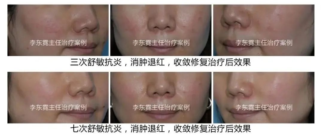 中年妇女面部色斑爆发怎样消除,女性色斑的最佳治疗方法