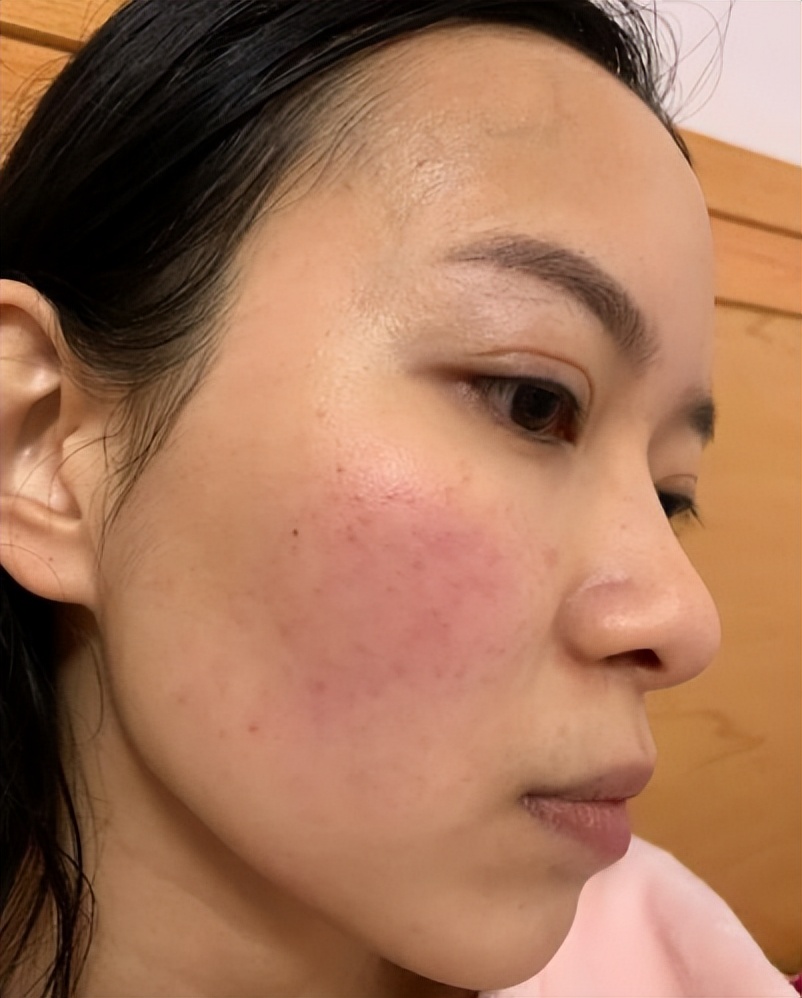 硫磺皂洗脸后皮肤刺痛感怎么办,经常用硫磺皂洗脸对皮肤有坏处吗