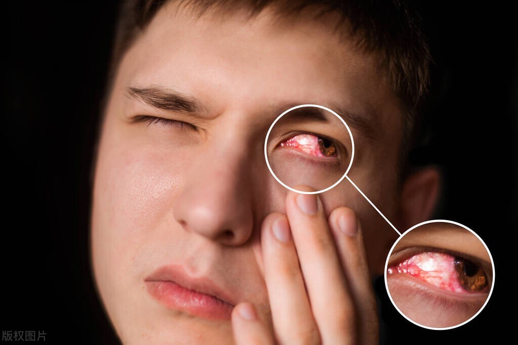 眼睛肿了为什么会流黄色东西,眼睛肿了睡觉还流出黄色粘稠物