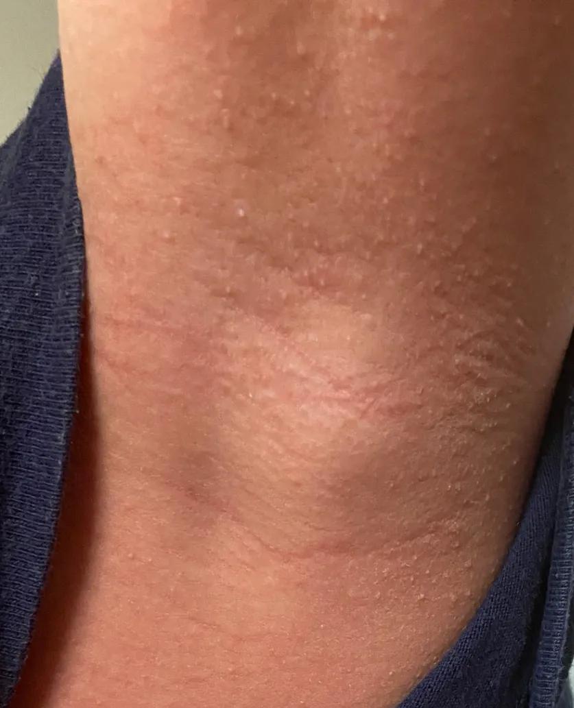 儿童发热后有红点是怎么回事,儿童发热后身上起红疹子