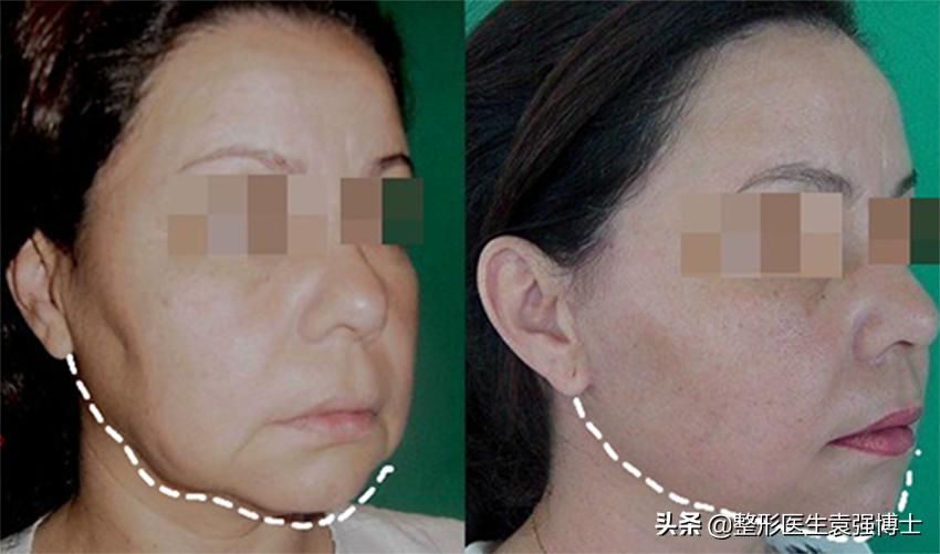 30岁脸开始发腮,40岁后脸好像没那么方了