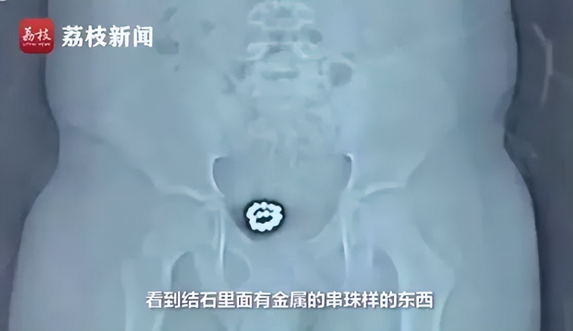 7岁女孩死亡体内却有异物,少女体内被埋神秘异物