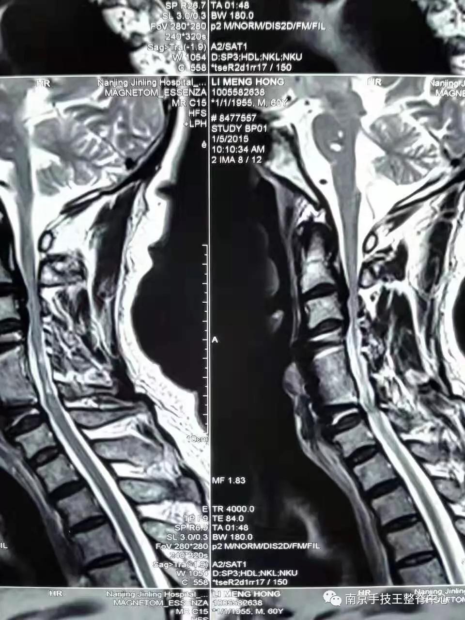 脊髓型颈椎病自愈的最快方法,脊髓型颈椎病的克星