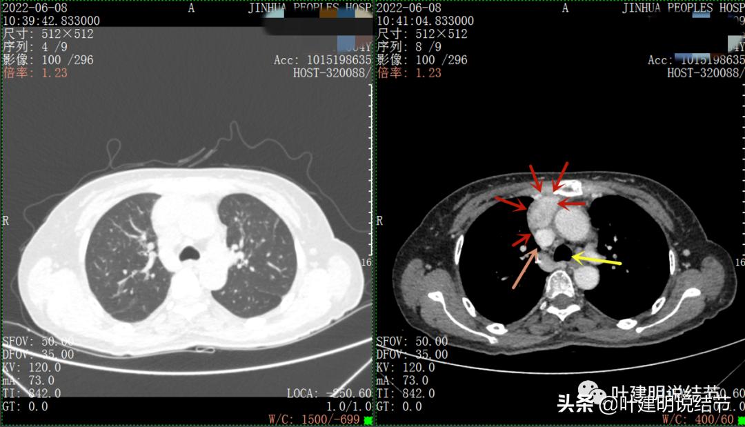 这位老乡，乏力来查，查出这么大个的纵隔肿瘤！会是什么呢？