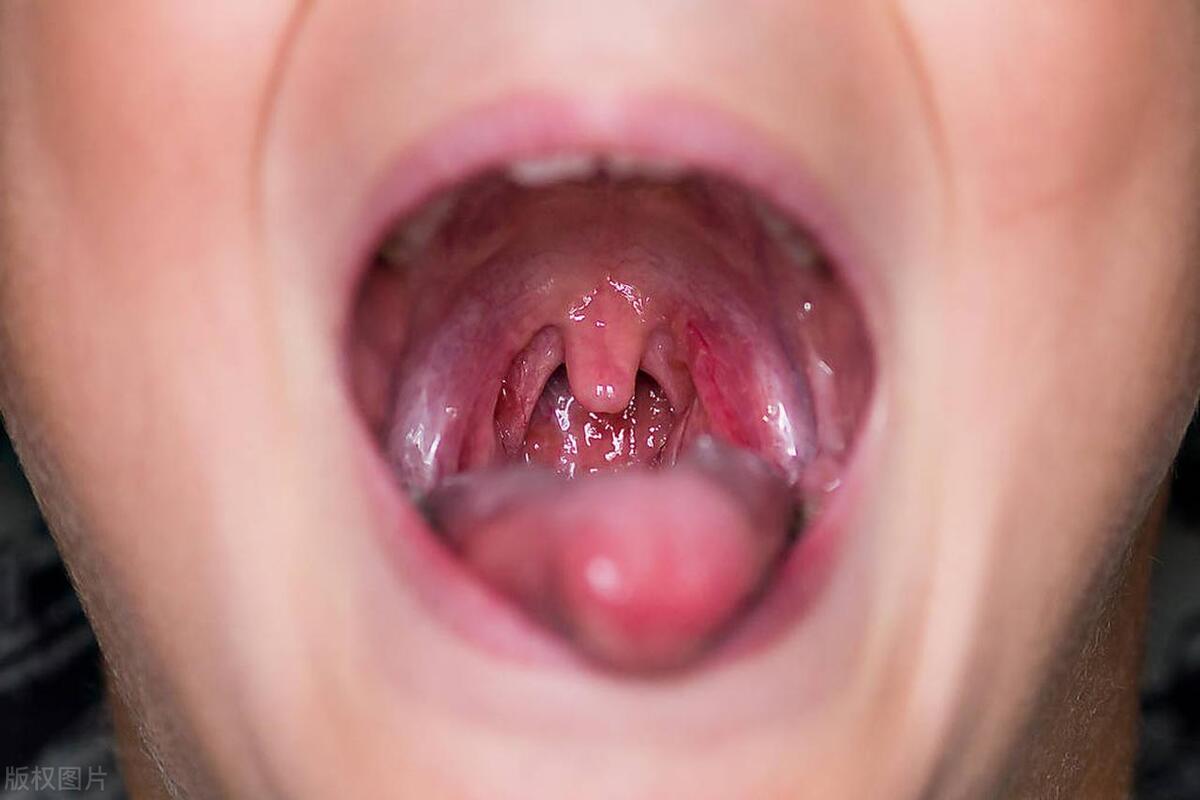 口臭1个小妙招10年口臭一去不复返,口臭根源与预防口臭妙招