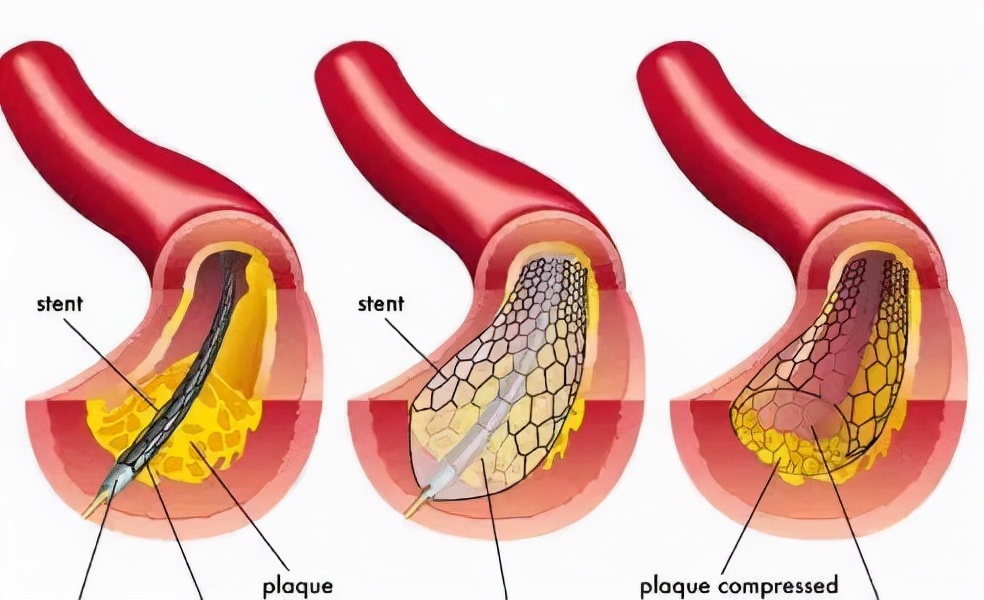 心脏支架是救治病人还是缺德害人,心脏支架是治病还是害人