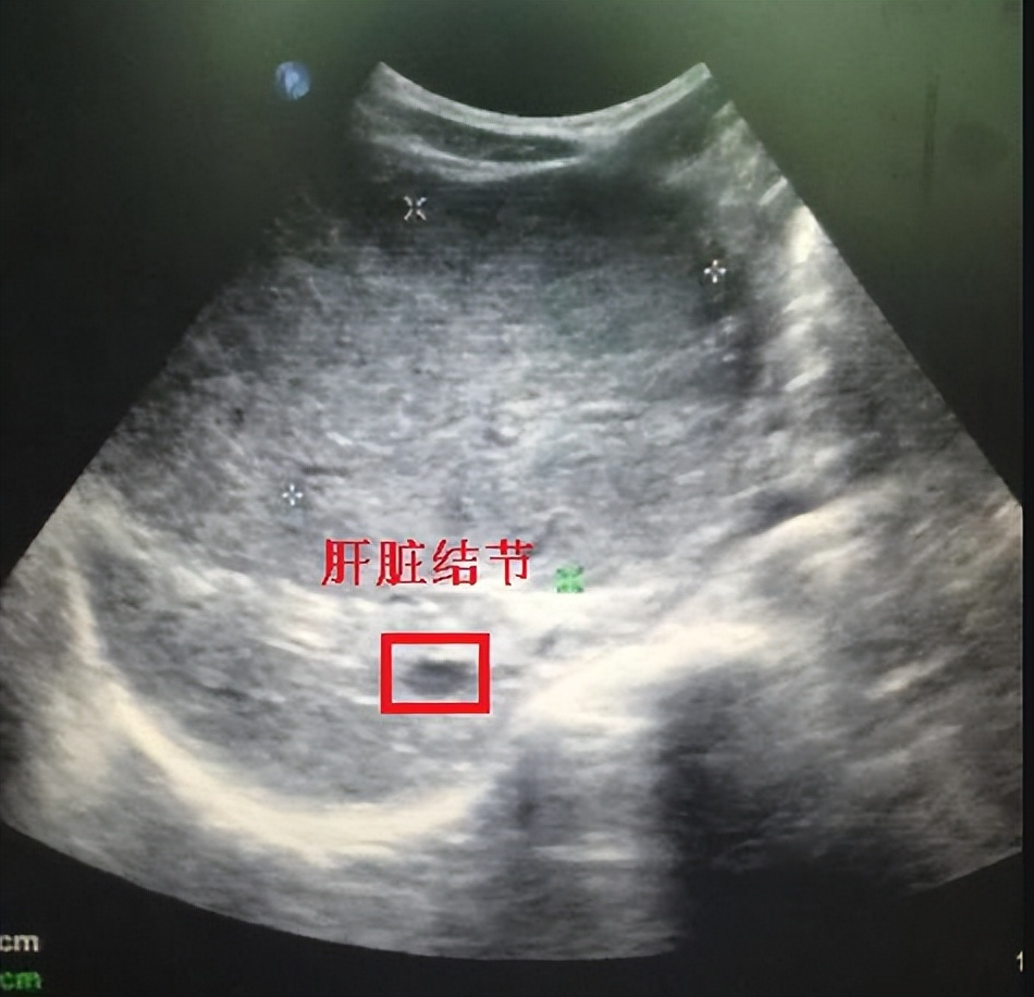 牛肉是发物甲状腺结节可以吃吗,牛肉是发物吗淋巴癌患者能吃吗