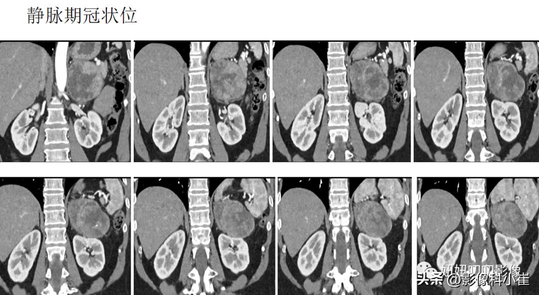 肾上腺疾病的诊断思路,肾上腺可能出现的病症有哪些