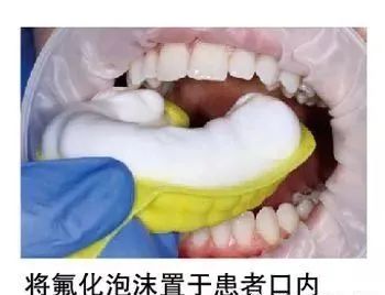 牙齿涂氟和打预防针有冲突吗,牙齿涂氟所有牙齿都要吗