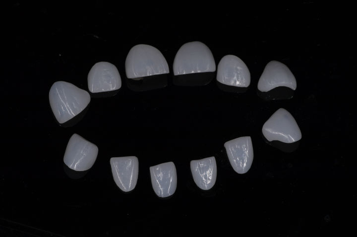 牙贴面会自己掉吗,牙贴面掉了几率大吗