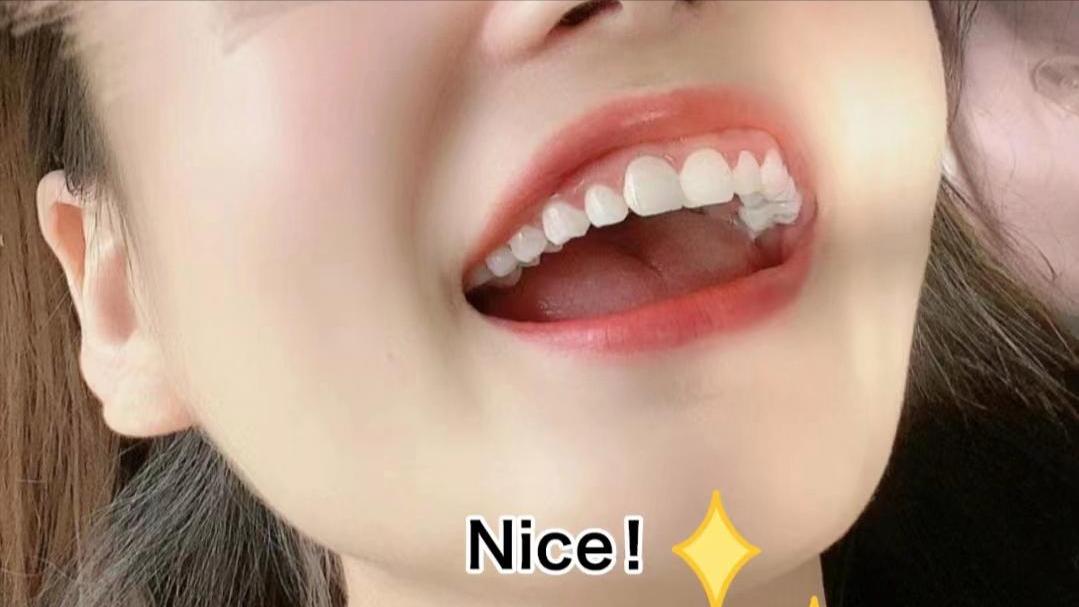 去除牙结石口臭小窍门,口臭小妙招去除牙结石