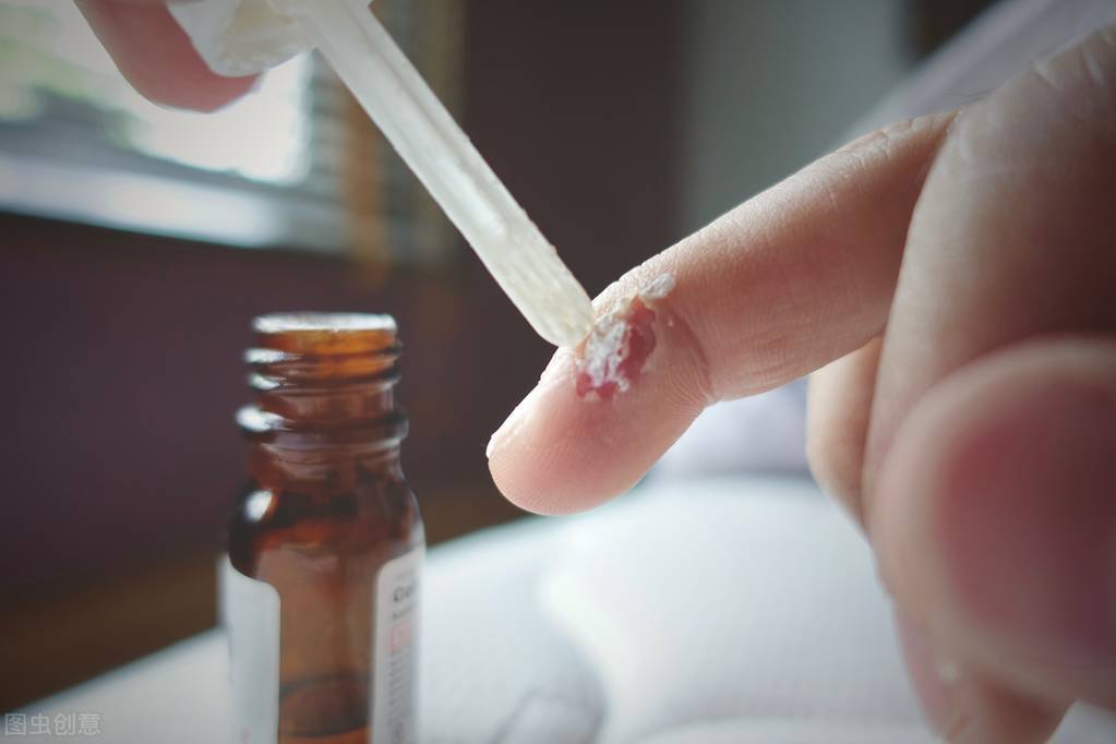 寻常疣扁平疣和跖疣,寻常疣与扁平疣哪个严重