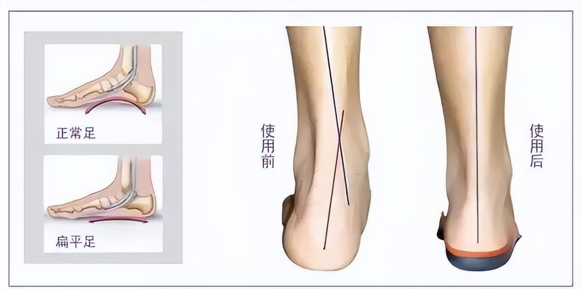 足弓消失的扁平足,改善足弓塌陷跪姿双脚要不要并拢