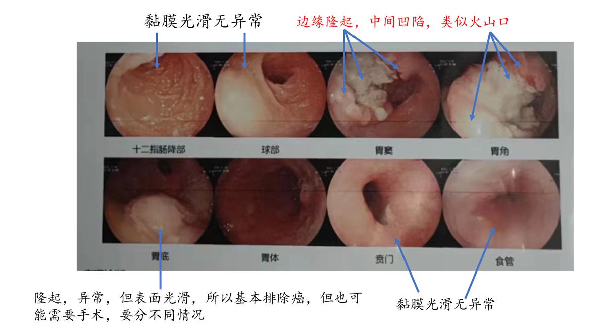 初学者怎样学习胃镜的操作手法,胃镜怎么做的过程图片解说