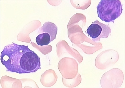重型再生障碍性贫血69岁能治好吗,再生障碍性贫血的早期症状和前兆