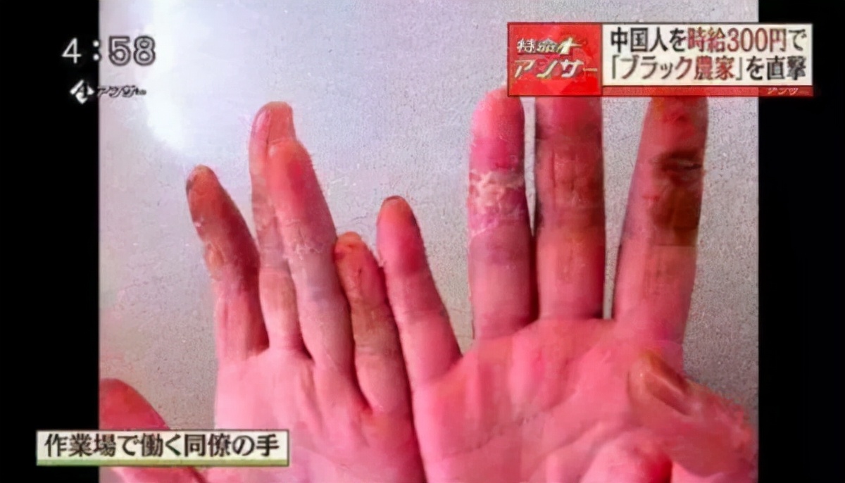 在日本打工的中国人,女的被*辱侮**后跳楼,男的断三根手指投诉无门