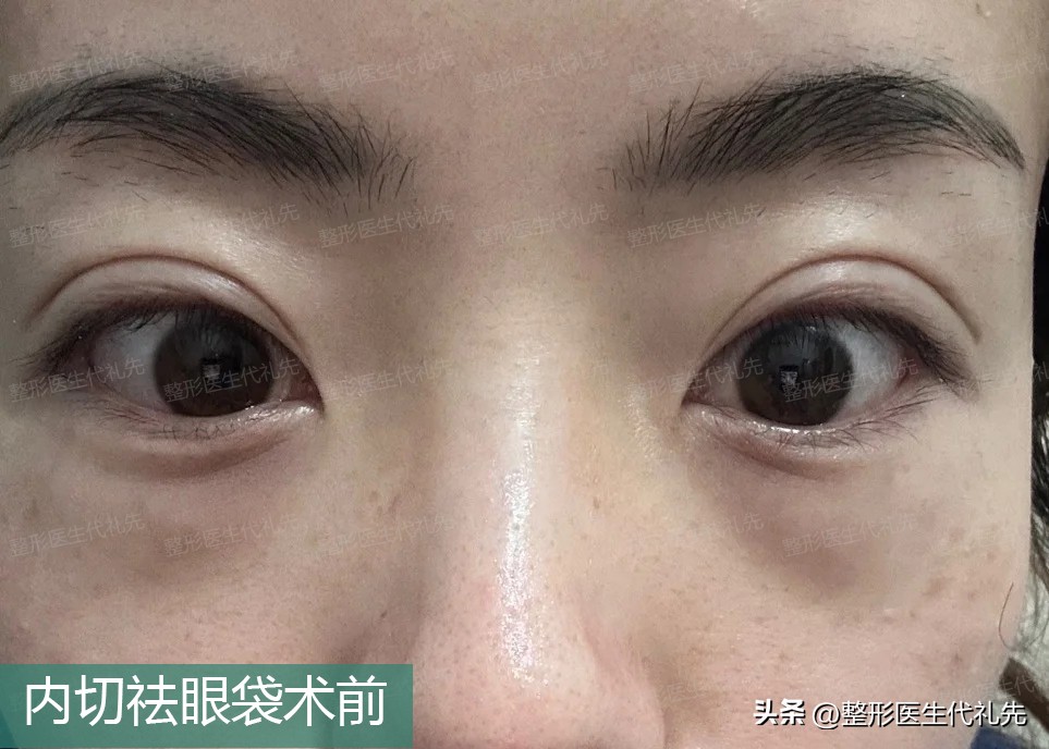内切眼袋后1-5天恢复图,内切眼袋恢复后对比图片