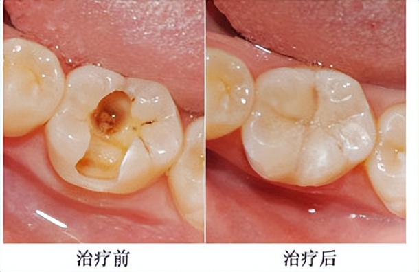 烂牙残根不拔的危害大吗,有没有治坏牙的好方法