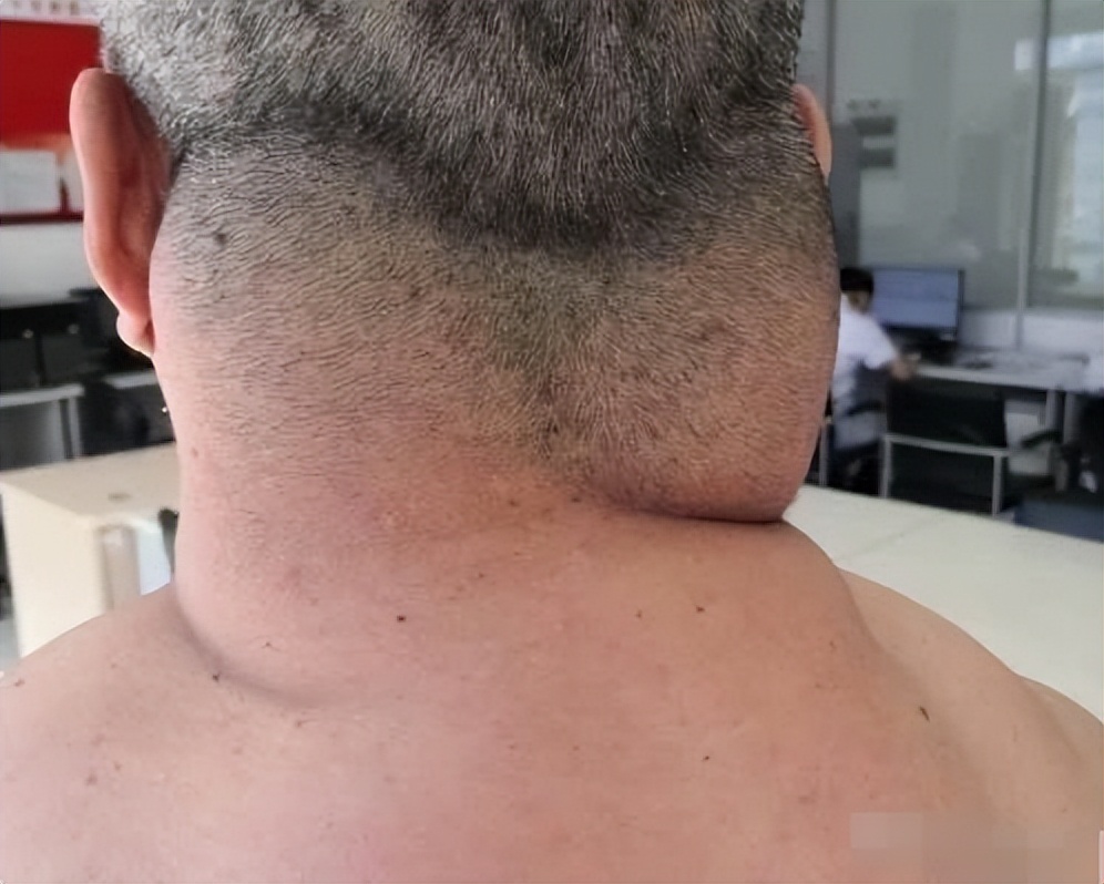 62岁大叔喝出河马脖,辽宁男子喝酒成河马