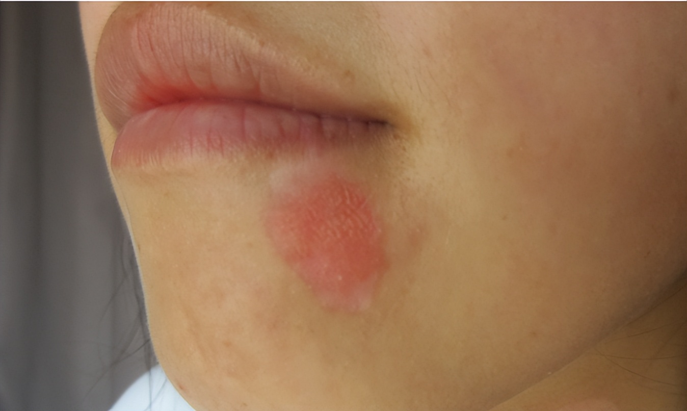 成年人脸部白斑怎么治疗最有效,儿童面部白斑消除最简单方法