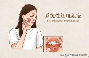 鼻子旁边有红斑是怎么回事,鼻子周围红斑是肺的问题吗