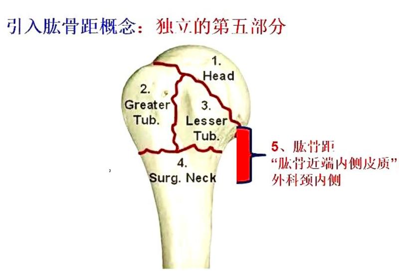 肱骨近端骨折属于几级伤残,肱骨近端骨折康复训练技巧