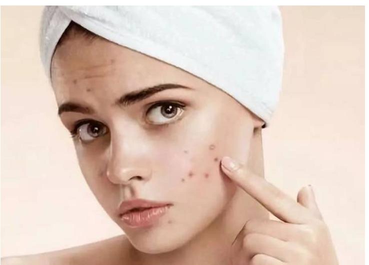 如何有效改善红痘印和黑痘印,白痘印和黑痘印哪个更容易遮盖
