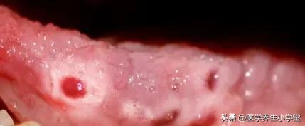 嘴巴一直长溃疡是什么原因,嘴巴经常长溃疡是什么原因引起的