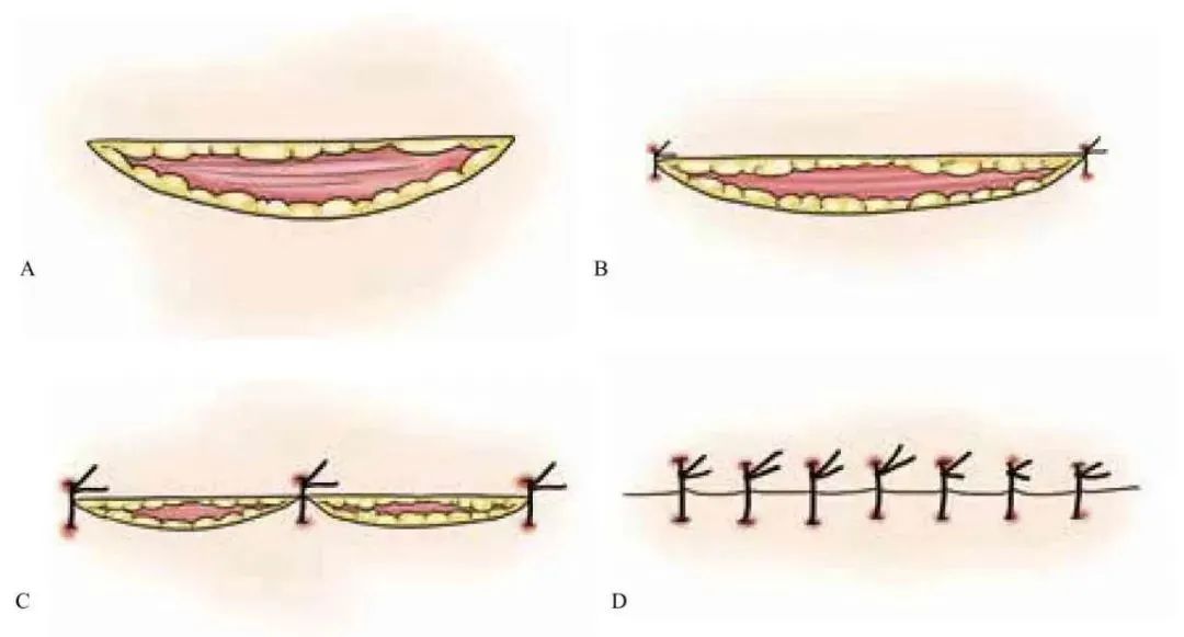 3分钟get:真正的外科缝合秘籍