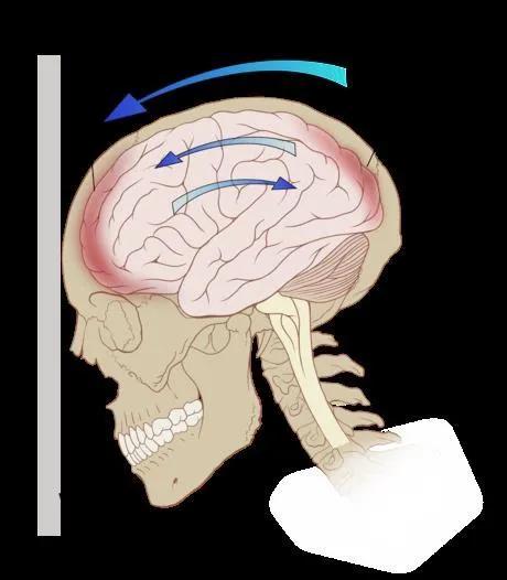 轻微脑震荡对记忆有影响吗,脑震荡对大脑有危害吗