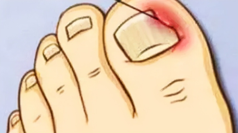 脚趾甲往肉里长又疼又痒教你一招,脚趾甲没有甲沟炎为什么一碰就疼