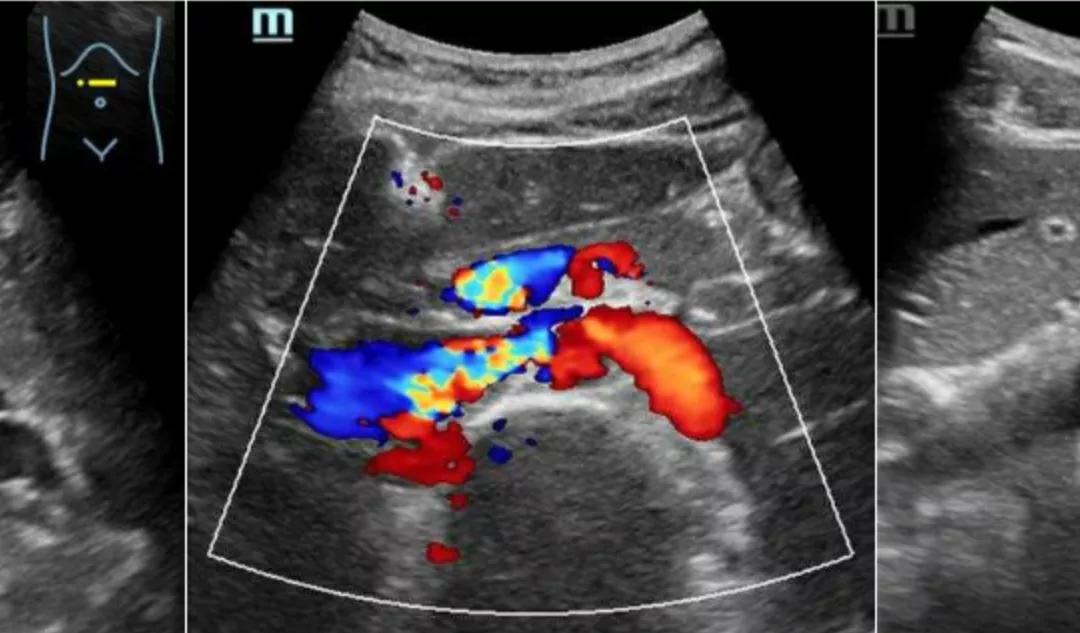 胡桃夹综合征持续尿血腰疼,女胡桃夹综合征会一直尿血吗
