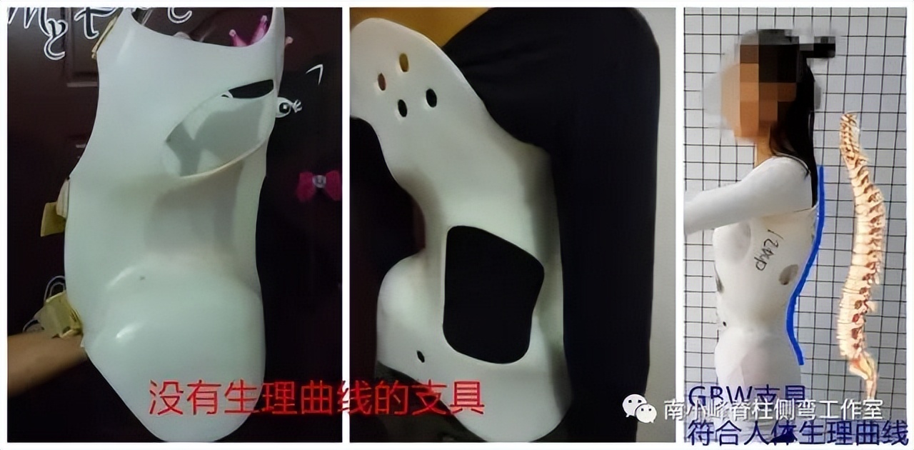脊柱侧弯矫正支具不调整会怎样,简单辨别脊柱侧弯避免孩子走弯路