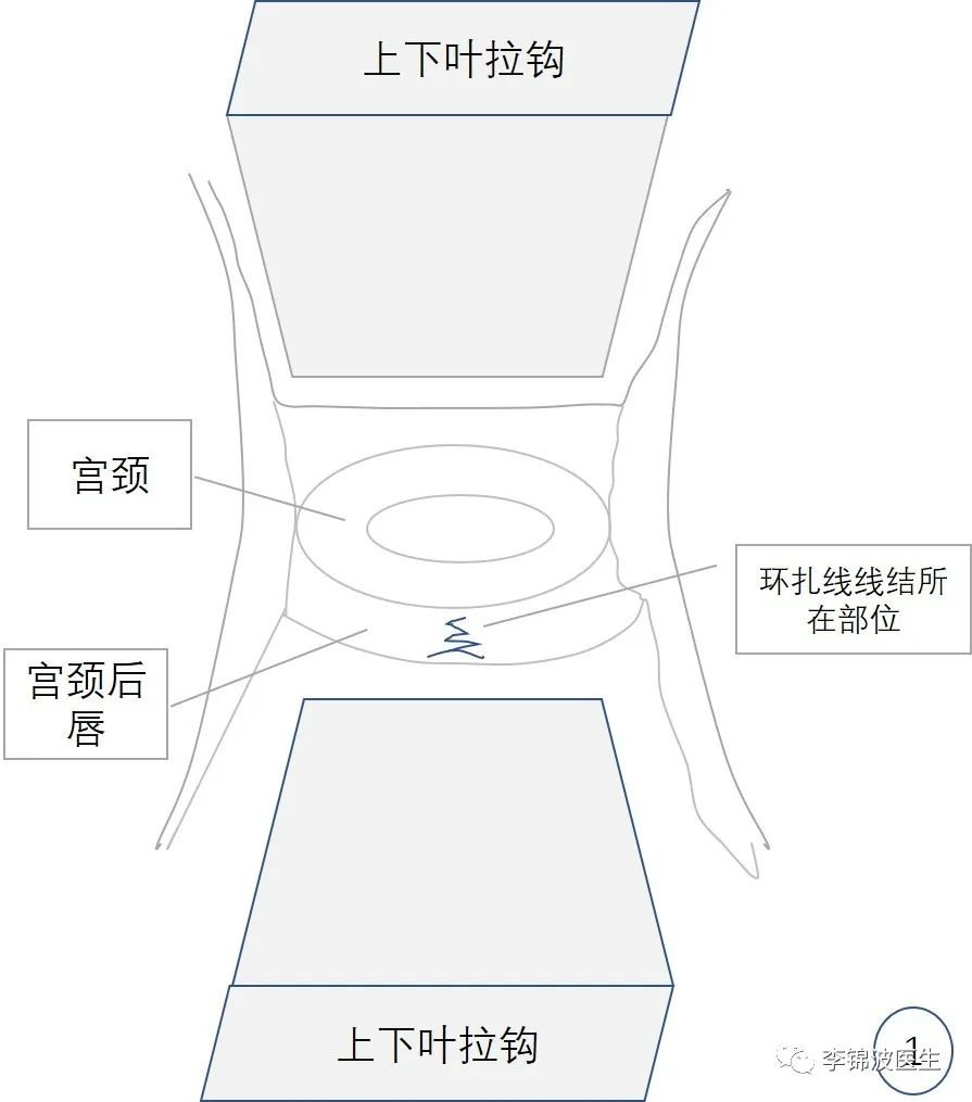宫颈环扎术的详细步骤,宫颈环扎线拆除多少钱