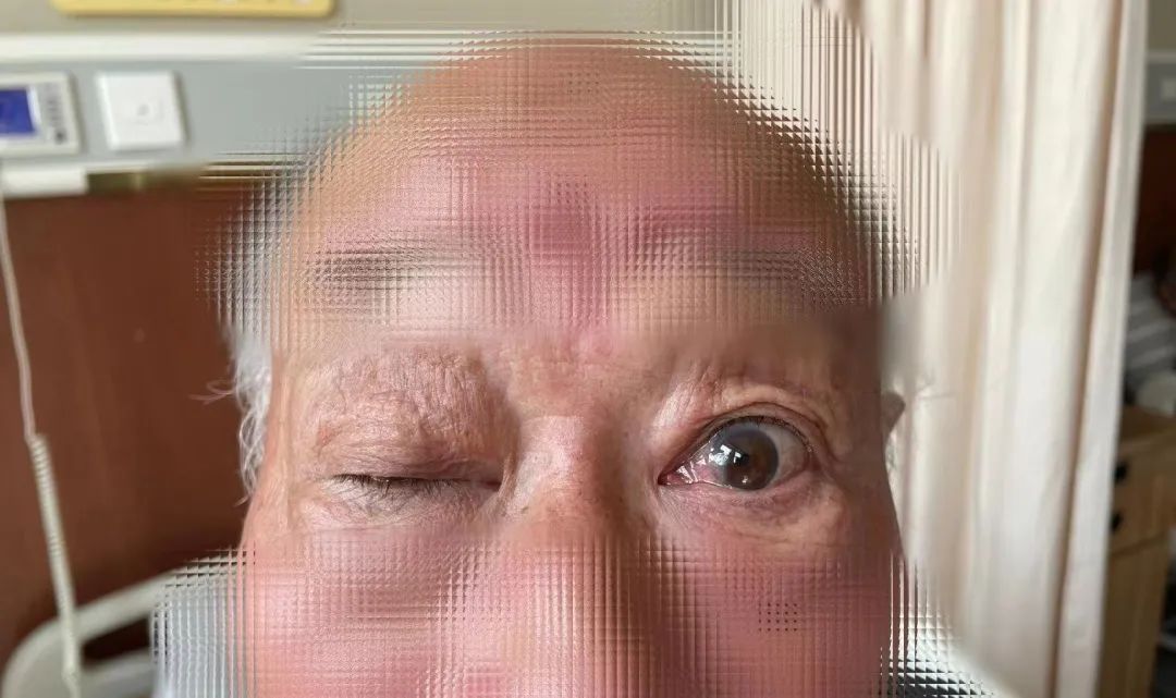 眼皮抬不起来了真困,眼皮抬不起来是阳吗