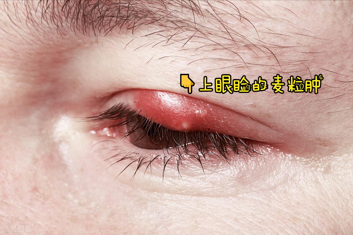 眼皮长了个小疙瘩怎么去掉,右眼皮上长了个小疙瘩预兆