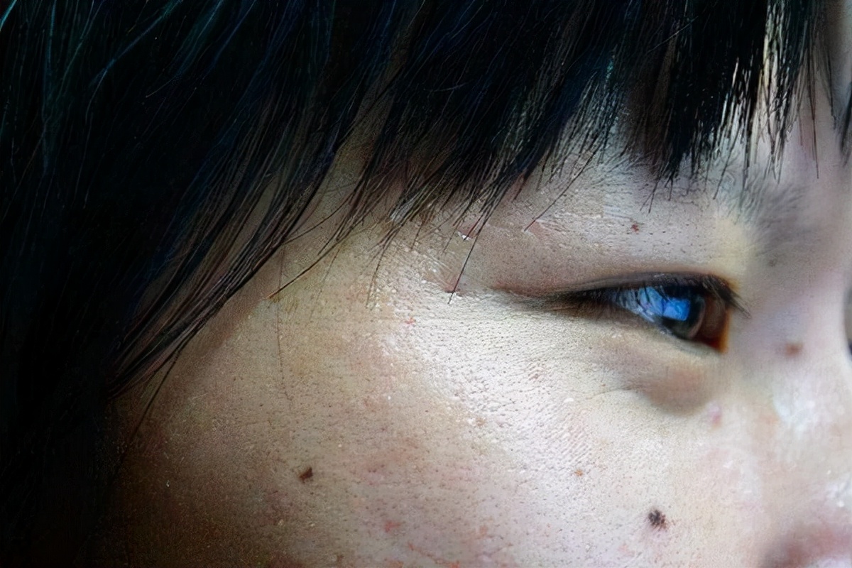 怎么在医院确定黑痣是不是良性的,黑痣隆起挂什么科检查