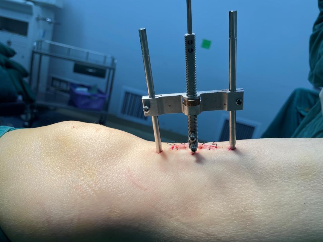 糖尿病足小发明,胫骨皮瓣移植治疗糖尿病足