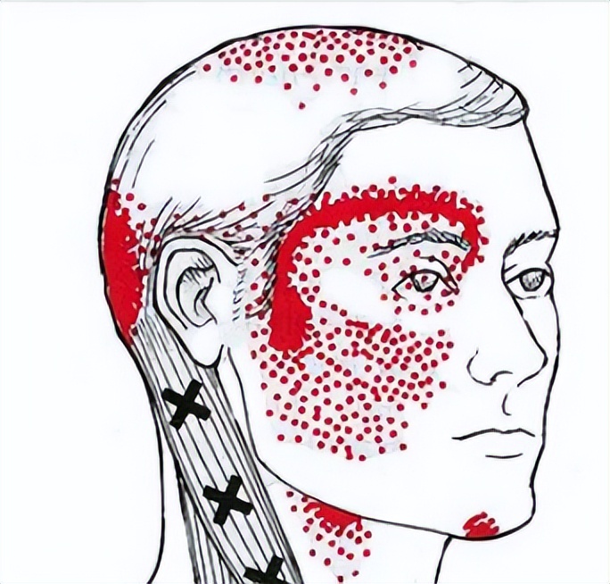 颈复康治疗颈源性头痛吗,颈源性头痛整体解决方案
